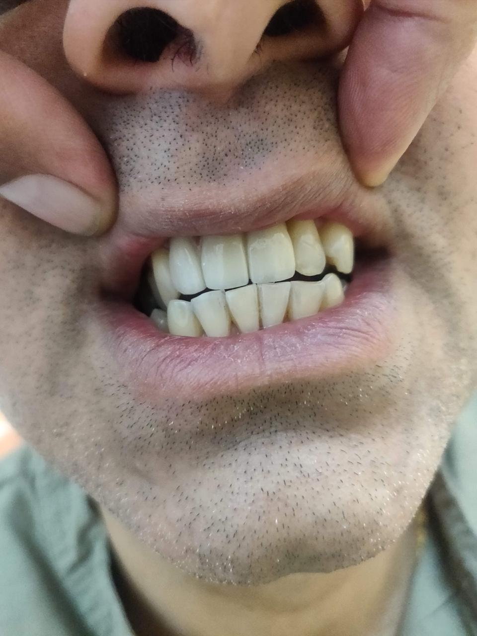 Final Prosthesis