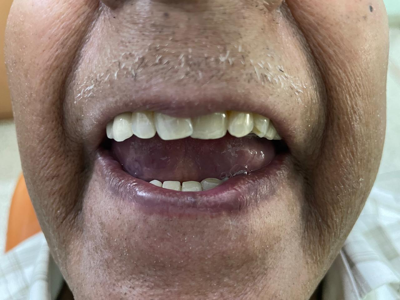 Implant- Post Prosthesis