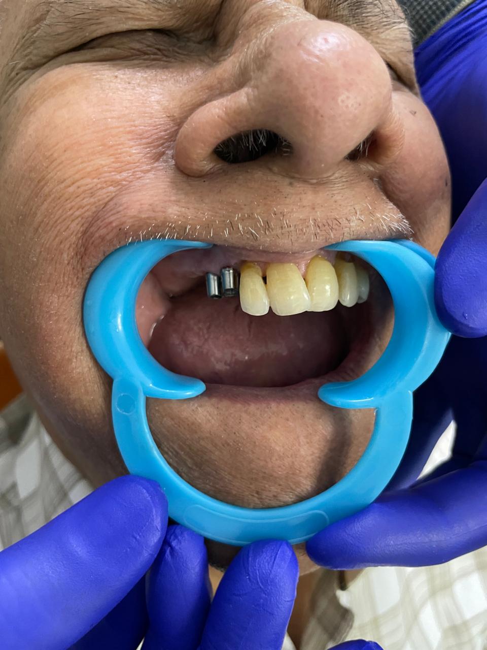 Implant Post Implant Placement