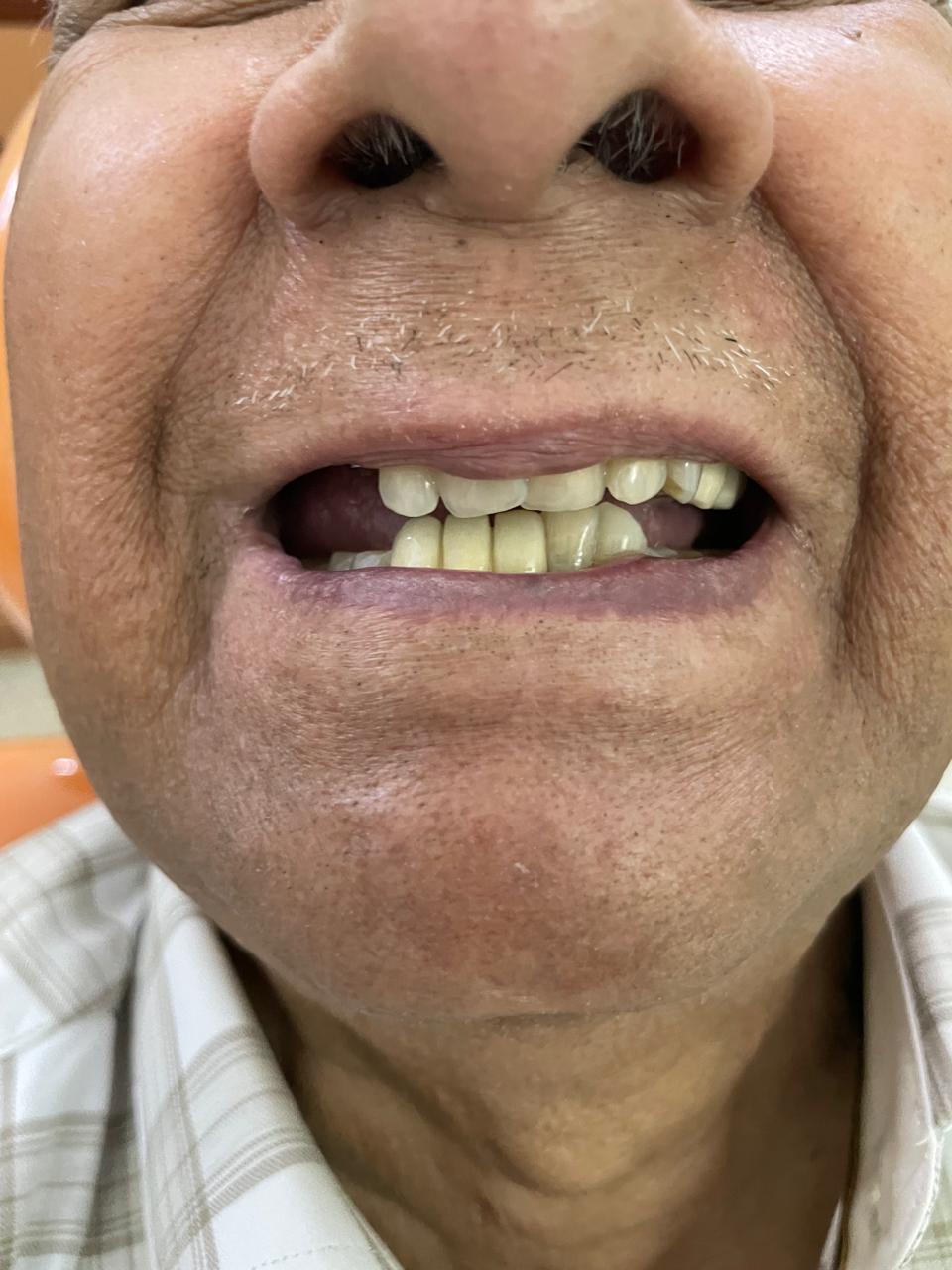 Implant Pre Operation