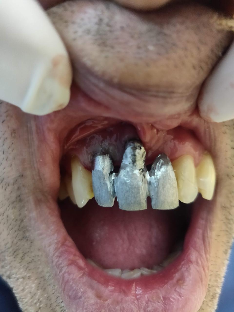 Implant Prosthesis Metal trial