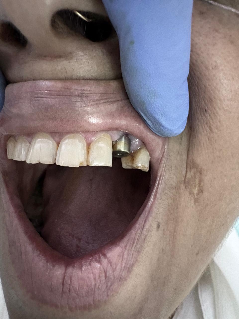 Implant Post Implant Placement