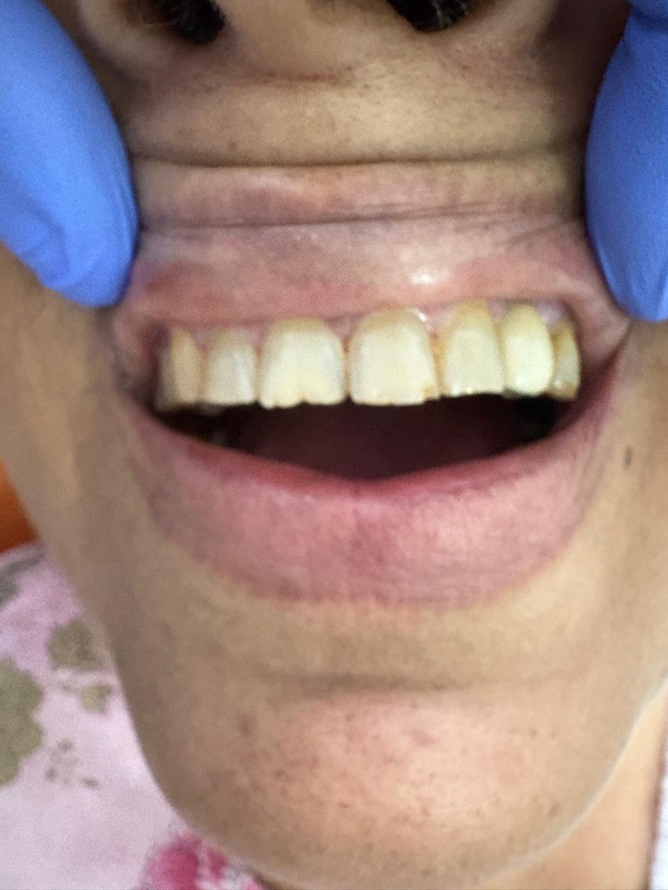 Implant- Post Prosthesis